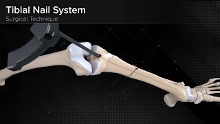 Tibial Nail System—Standard Surgical Technique