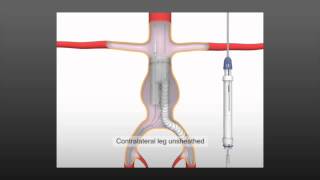 Anaconda AAA Stent Graft System - Vascutek, a Terumo Company