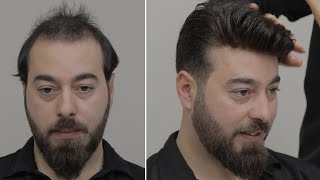 PROTEZ SAÇ UYGULAMASI - Hair Replacement