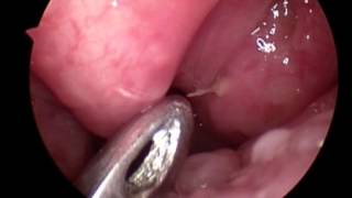 Foreign Body  Throat | Fish Bone | Endoscopic Removal