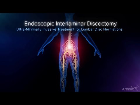 Endoscopic Spine Surgery New Hampshire Orthopaedic Center