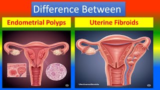 Differance between endometrial polyps and uterine fibroids
