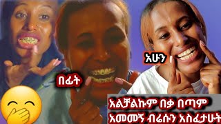 በቃ አልቻልኩም በጣም ስለአመመኝ ብሬሱን አስፈታሁት ለሁላችሁም ጥንቃቄ መጀመሪያ ጥርሳችሁን ብሬስ መሰራት ከፈለጋችሁ ማድርግ ያለባችሁ ነገሮች Teeth