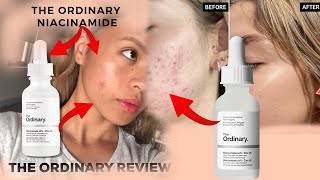 The Ordinary Niacinamide - ক্ষতিছাড়া স্কিন ব্রাইটেনিং।ব্লেমিস দূর।পোরস পরিস্কার - 100% Authentic