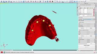 BlueSkyPlan Guide - Aligning Angled Abutments