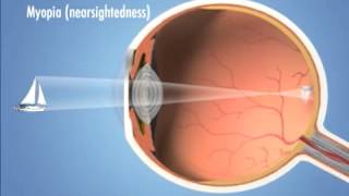 Four Main Types of Refractive Error (vision problems) - Eye Associates