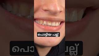 പല്ലില്ലെ കറ ,പൊട്ടിയ പല്ല്   Smile Correction cheyam with composite veneers #dentaltreatment