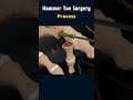 hammer toe surgery understanding the procedure surgeryanimation