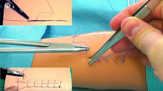 Learn all kinds of continuous suturing of wounds