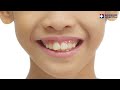 invisalign จัดฟันแบบใส เพิ่มความมั่นใจในทุกครั้งที่ยิ้ม by bangkok hospital