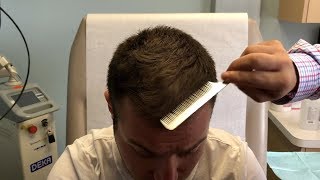 TOPICAL FINASTERIDE FOR MALE PATTERN HAIRLOSS -- REAL PATIENT TESTIMONIAL