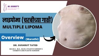 लाइपोमा (चरबीच्या गाठी) | Everything you need to know about Multiple Lipoma | Marathi | Dr. Sushrut