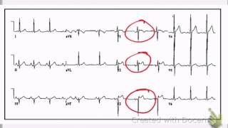 ECG In syncope