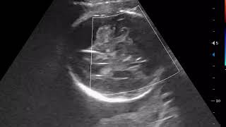 CASE 253 3D 4D FETAL DWS