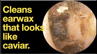 Cleans earwax that looks like caviar. |ear wax removal | ear cleaning | ASMR | relaxation | relax