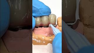 Ensuring the patient can easily floss a Bridge Implant #lsk121shorts #dentistteeth #smile