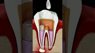 Root Canal Explained in 60 Seconds! ✨ Save Your Tooth Today!