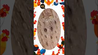Blackheads Removal | Acne Treatment and Very Satisfying Satisfying Pimple pop #blackheads