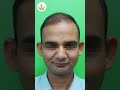 Hair Transplant Before and After Result: Shocking Reveal | Care Well Medical Centre #shorts