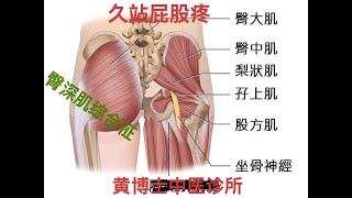 久站屁股疼｜久站腿麻木｜臀部深肌综合征| 奥克兰中医针灸正骨诊所