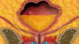 Complications of overactive bladder - Animated Atlas of BPH and OAB
