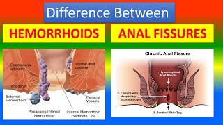 Difference Between Hemorrhoids and Anal Fissures