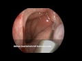 Eustachian Tube Dysfunction Treatment with Balloon Eustachian Tuboplasty / Dilatation