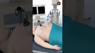 How Gastric Bypass Surgery Is Done? #3danimation