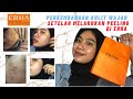 UPDATE PERKEMBANGAN KULIT WAJAH BERJERAWAT SETELAH TREATMENT PEELING DI ERHA