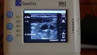 Sonosite 180 Plus