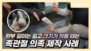 👢가죽 의족으로 상처가 더 커진 환부를 위해 새로 제작한 실리콘 맞춤제작 족관절 의족🦶