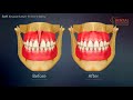 soft tissue laser frenectomy for reducing gap between teeth