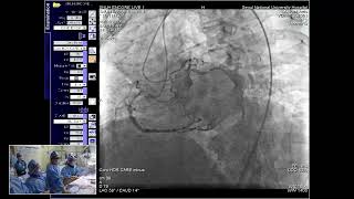 관상동맥 완전폐쇄 성공사례 (CTO 1) - ENCORE SEOUL 2024 LIVE Demonstration _ Hyo-Soo Kim, MD/PhD,  서울대학교병원 (SNUH)