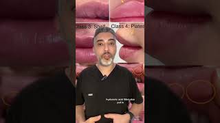 Lip Filler Migration - What it is, how to treat and prevent it.