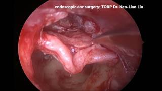 內視鏡中耳炎手術 聽小骨重建手術 TEES ossiculoplasty with Titanium TORP Dr. Ken-Liao Liu