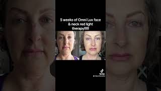 Not sponsored! Omnilux review. #bcmetathriver #livingwithstage4cancer