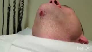 Huge ingrown hair