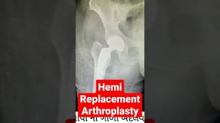 Bipolar Hemi Athroplasty| Hemi Replacement for hip fracture| Neck Femur fracture |Geriatric surgery