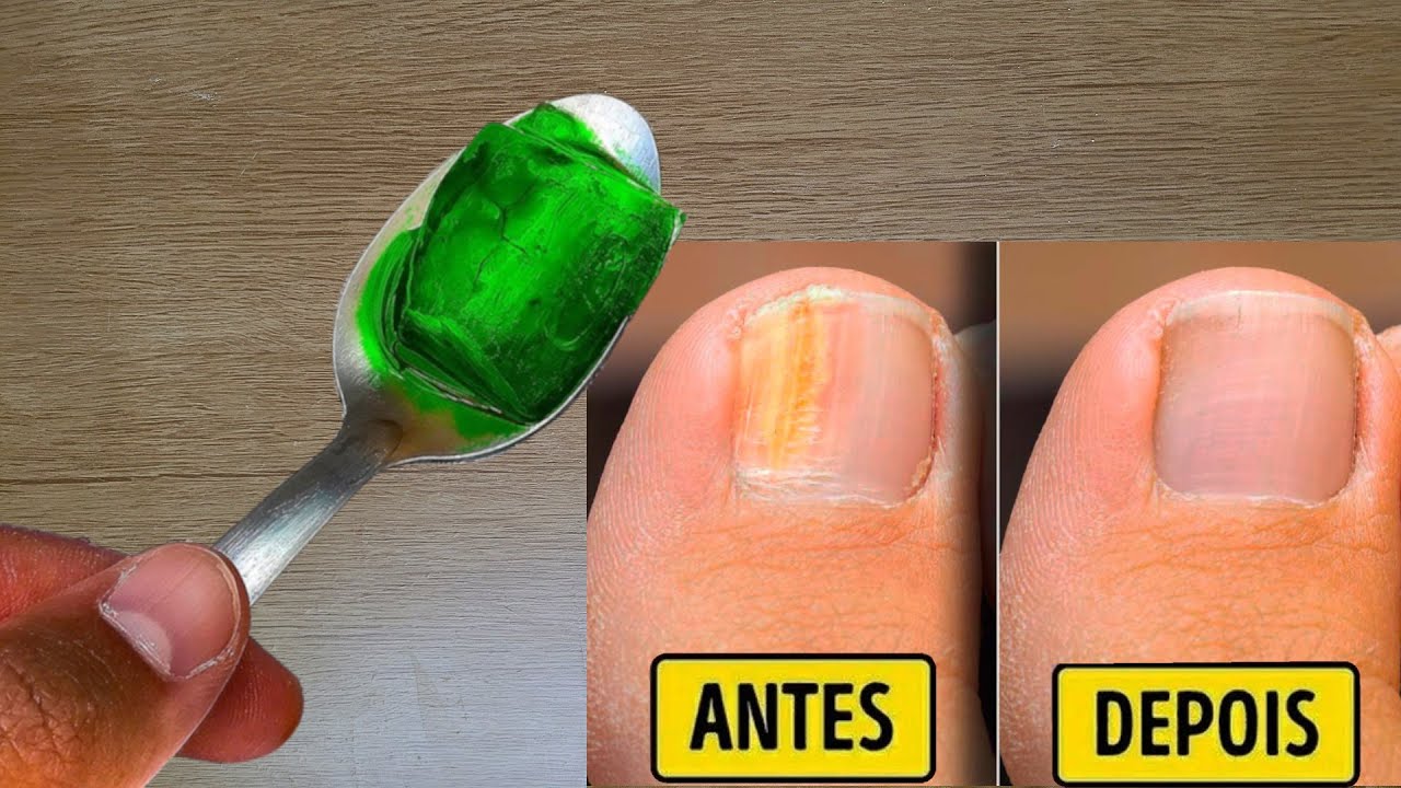 Morria E Não Sabia Melhor Receita Caseira Para Eliminar Micose De Unha