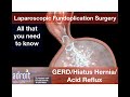 Acid Reflux (GERD, Hiatus hernia, heartburn, and acidity) treatment and laparoscopic surgery