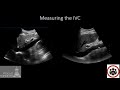 POCUS Cases 4: IVC POCUS for volume status