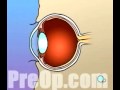 PreOp® Patient Education PRK Laser Eye 1.2