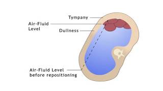 ASCITES AND SHIFTING DULLNESS elicited clearly