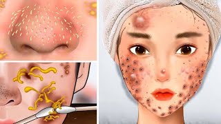 ASMR Warts, Big Acne & Black Head Pimple Removal in Face | Acne Deep Cleaning Animation skincare