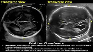 How To Measure Fetal Head Circumference (HC) On Ultrasound | Biometric Parameters | Obstetric USG