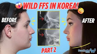 How is this even possible? Facial Feminization Surgery in Korea P.2 | Male to Female Transformation