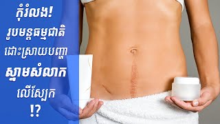 កុំរំលង រូបមន្តធម្មជាតិដោះស្រាយបញ្ហាស្នាមសំលាកលើស្បែក | Natural Formula To Deal With Scar On Skin