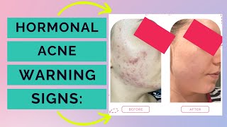 Hormonal Acne Symptoms - 6 WARNING signs you have hormonal acne