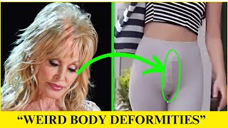 12 Celebrities...With Weird Body Deformities | Hollywood Discovery