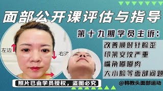 科学变美改善【明显型印第安纹➕嘴角嘟嘟肉➕大小脸➕面部肌肉下垂】等面部变丑问题《面部案例第19期》